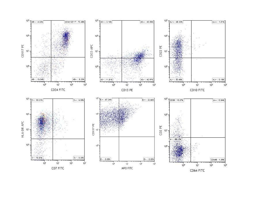 Flow cytometry histogram from initial diagnostic marrow